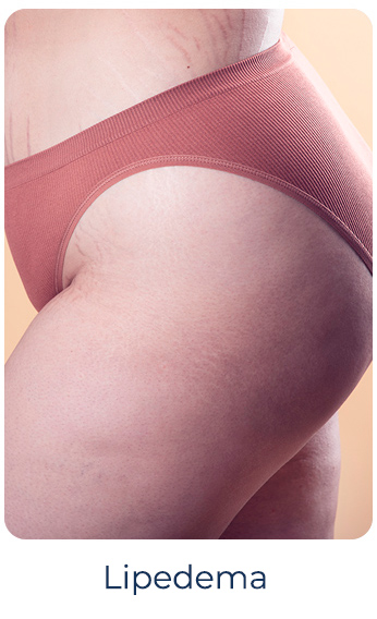tec_Lipedema
