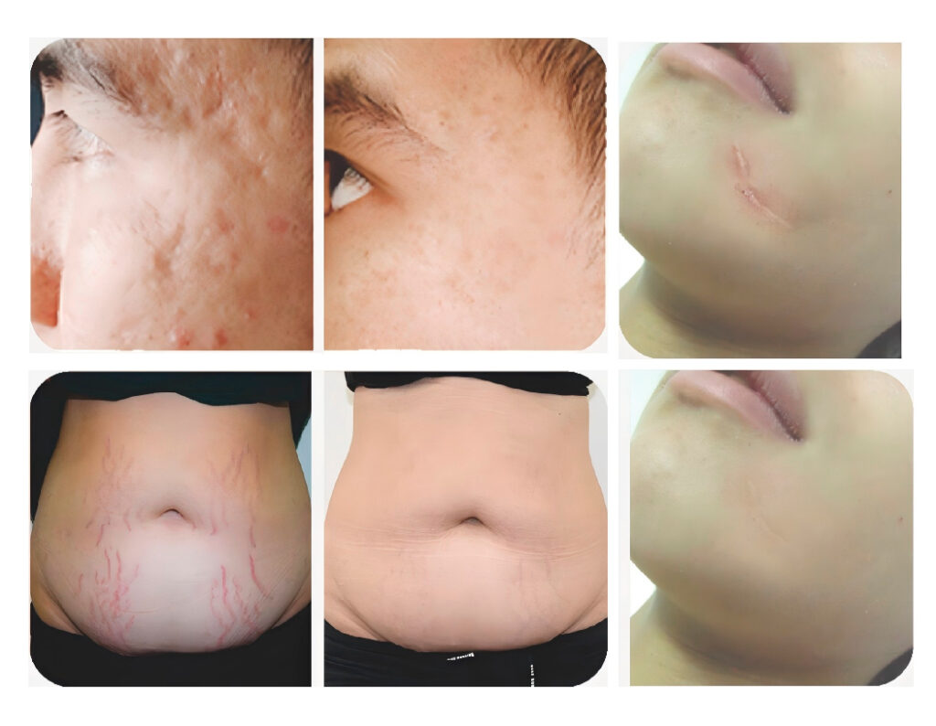 Resultados antes e depois - laser hs-232